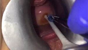 Cervix extreme gyno play